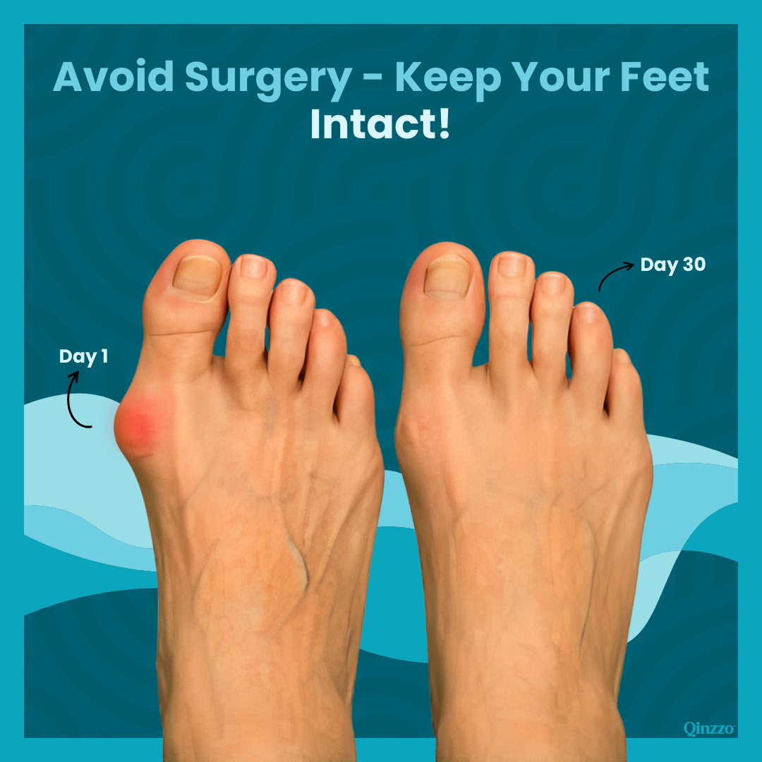 BunionEase™ Non-Surgical Fix